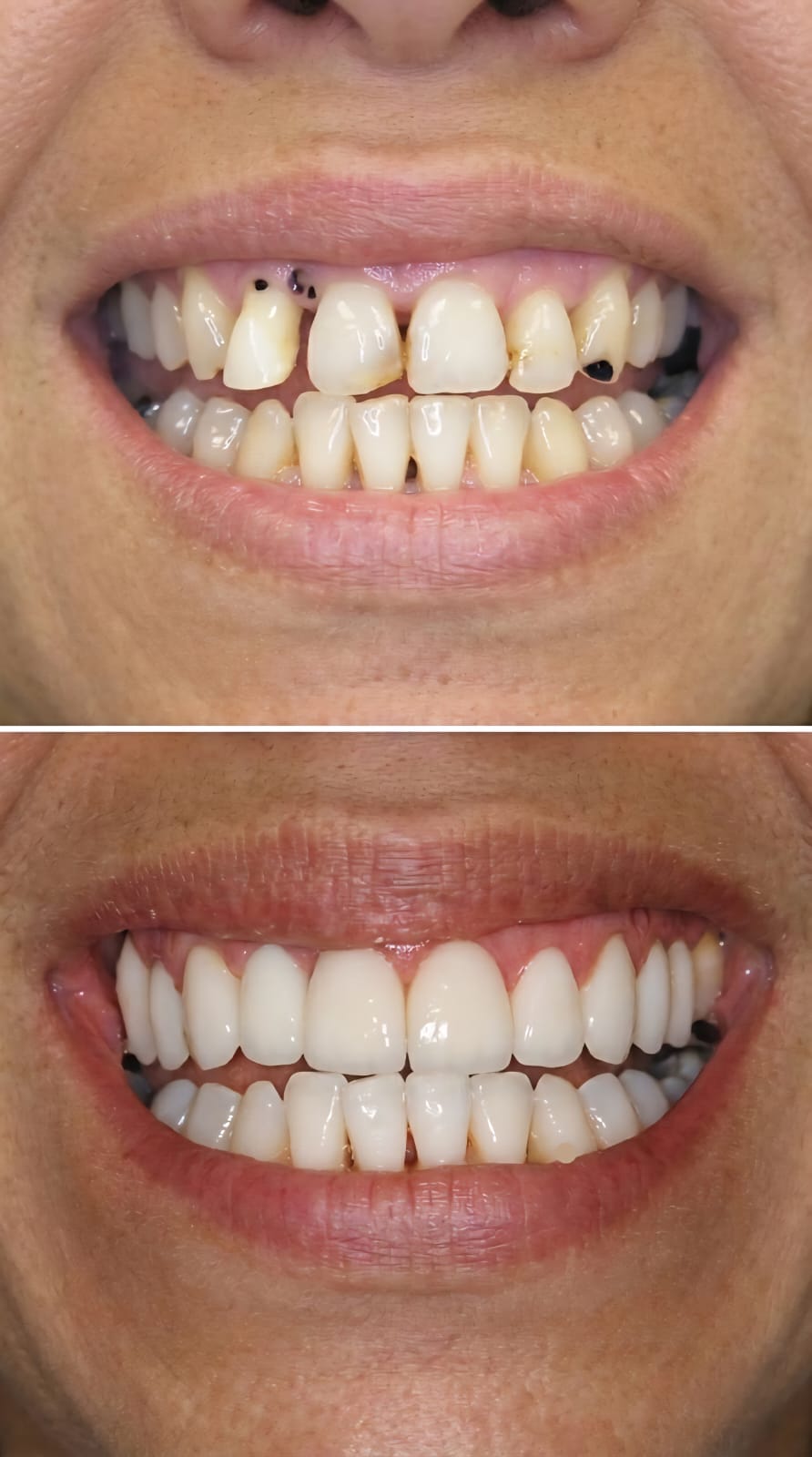Paciente sorrindo após tratamento de implantes na SC Dental
